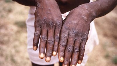 Namibia confirms first Mpox case